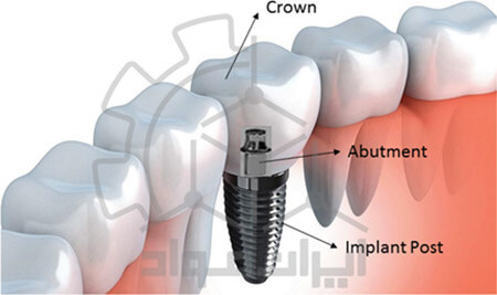 ایمپلنت دندان سرامیکی